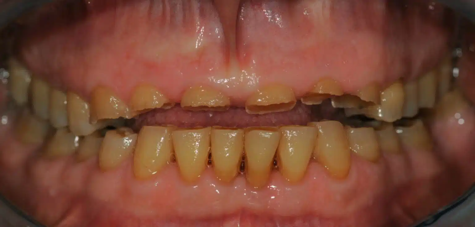 Usura dentale